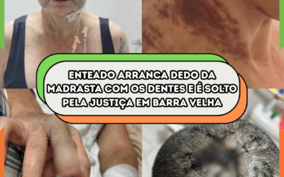 Enteado arranca dedo da madrasta com os dentes e é solto pela Justiça em Barra Velha