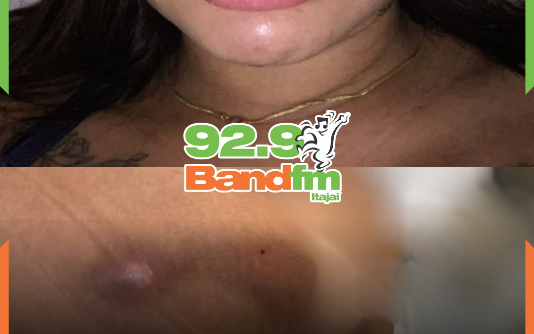 Falsa biomédica é indiciada após aplicar procedimentos estéticos ilegais e deixar 14 mulheres com sequelas em SC