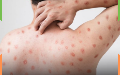 Primeiro caso de MPOX no Brasil é confirmado em Porto Alegre, no Rio Grande do Sul