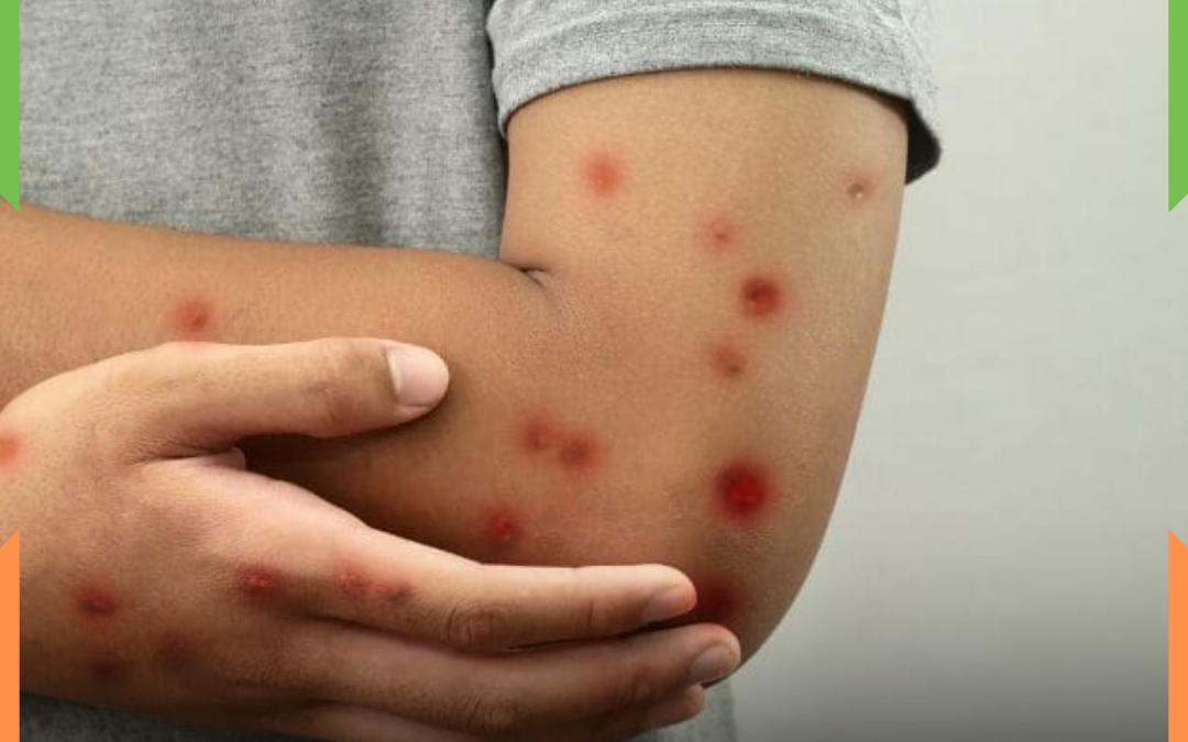 MPOX coloca Santa Catarina em atenção após notificações de casos suspeitos