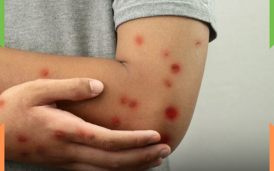 MPOX coloca Santa Catarina em atenção após notificações de casos suspeitos