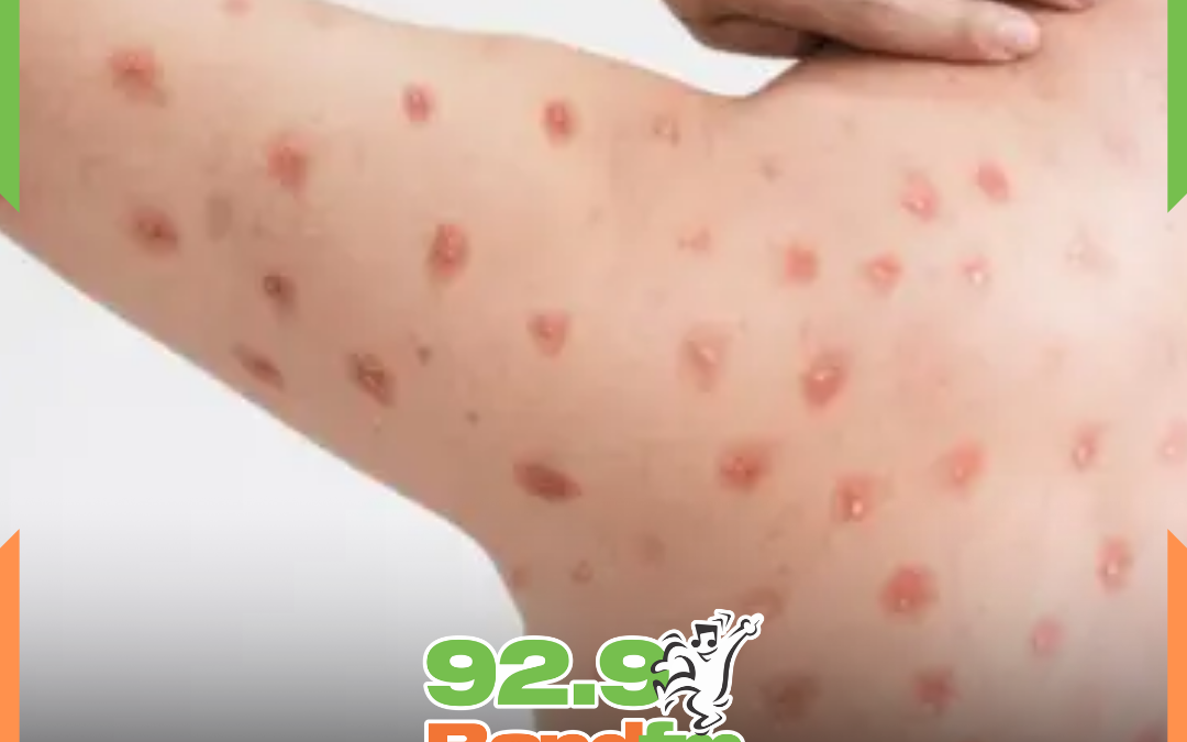 ALERTA SANITÁRIO: Santa Catarina investiga 16 casos suspeitos de MPOX